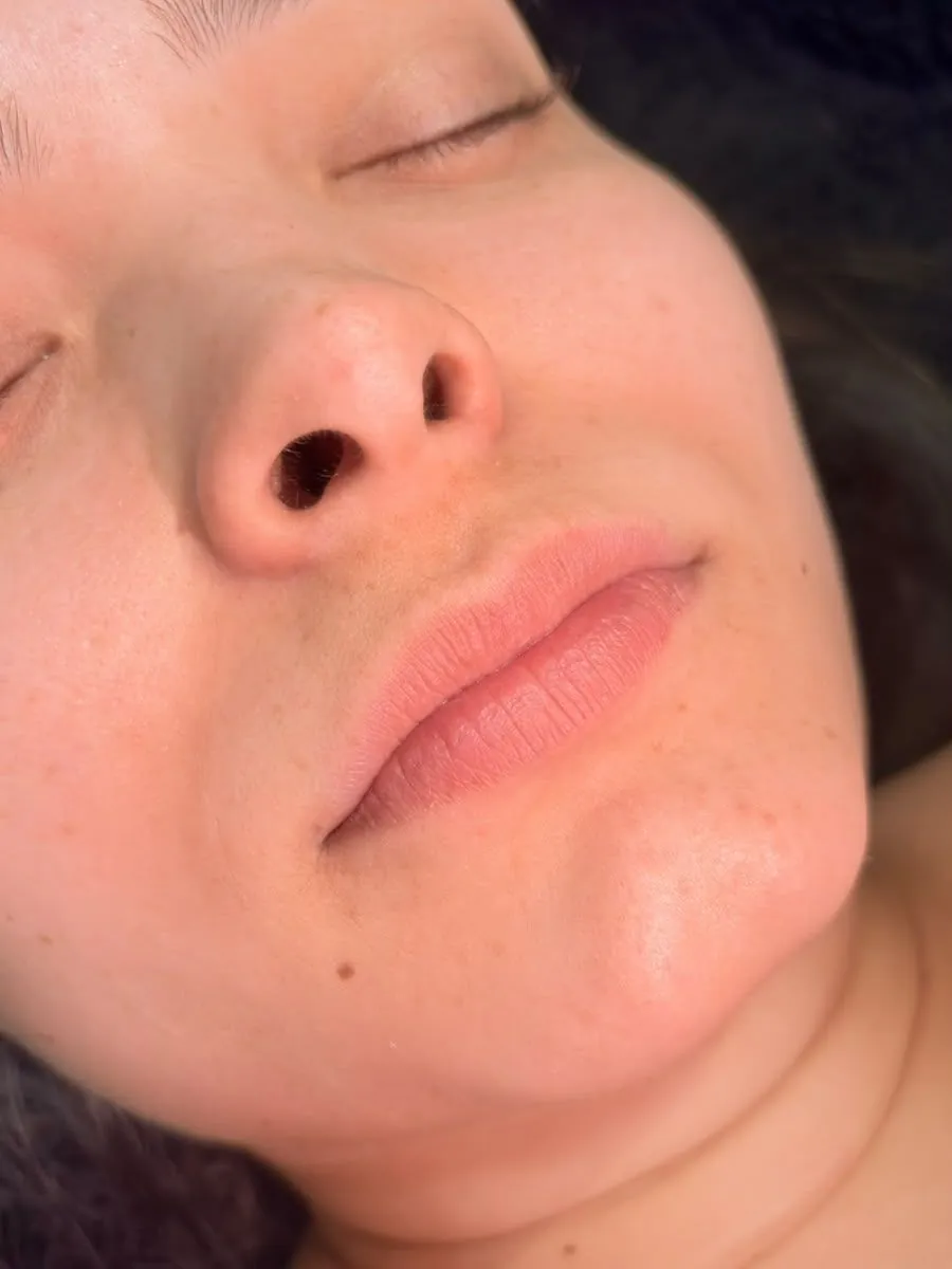 Antes — Preenchimento labial · contorno e volume sutil