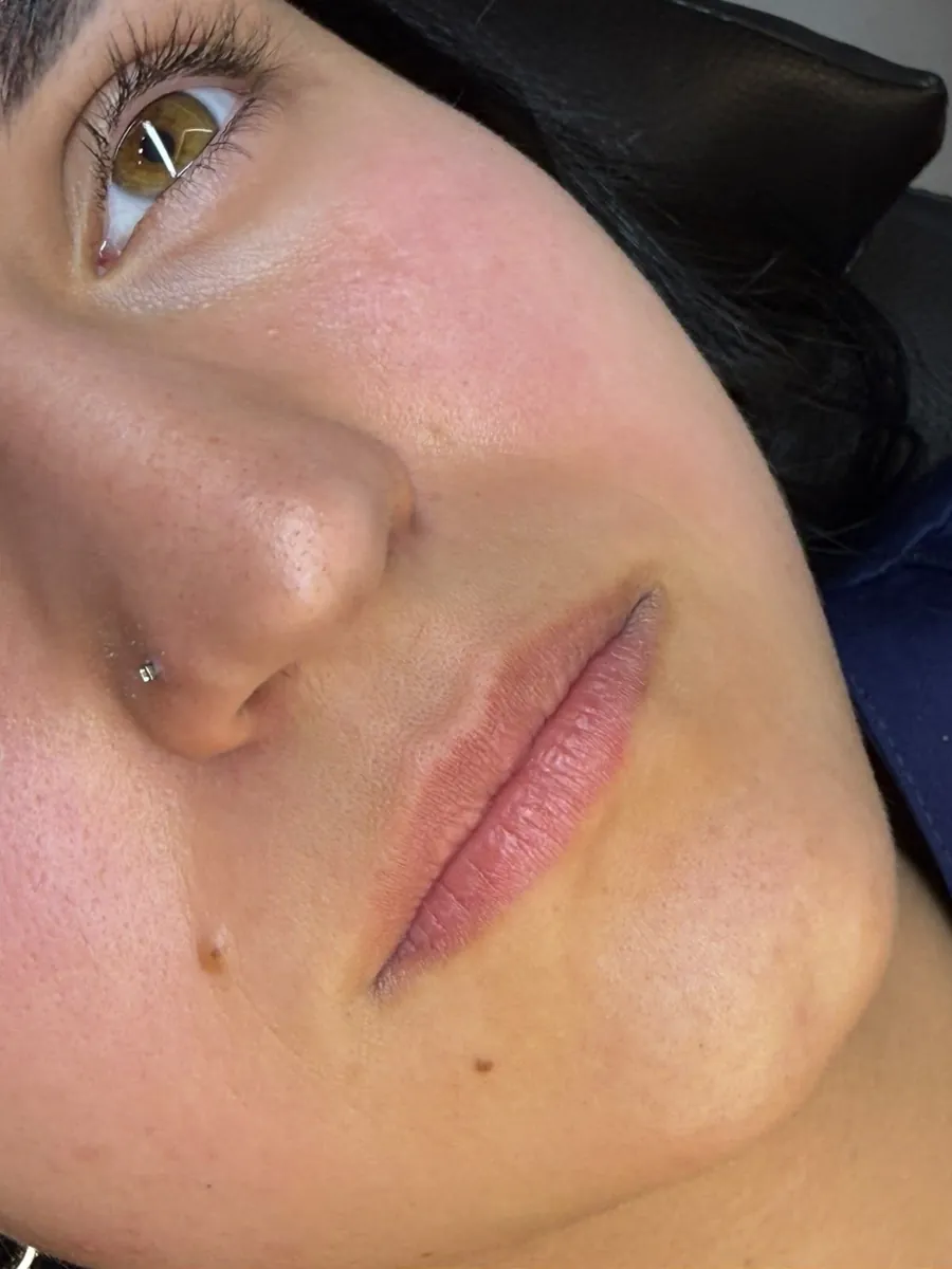 Antes — Preenchimento labial · hidratação e definição