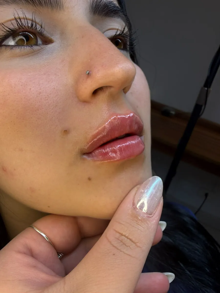 Depois — Preenchimento labial · hidratação e definição
